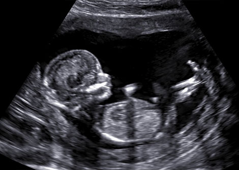 2d gender ultrasound - over the womb